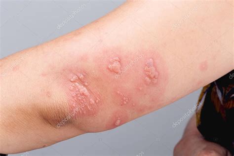 Shingles, Zoster or Herpes Zoster symptoms on arm — Stock Photo © toa55 ...