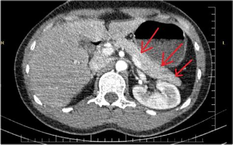 Axial abdominal CT scan with IV contrast at pancreatic level shows ...