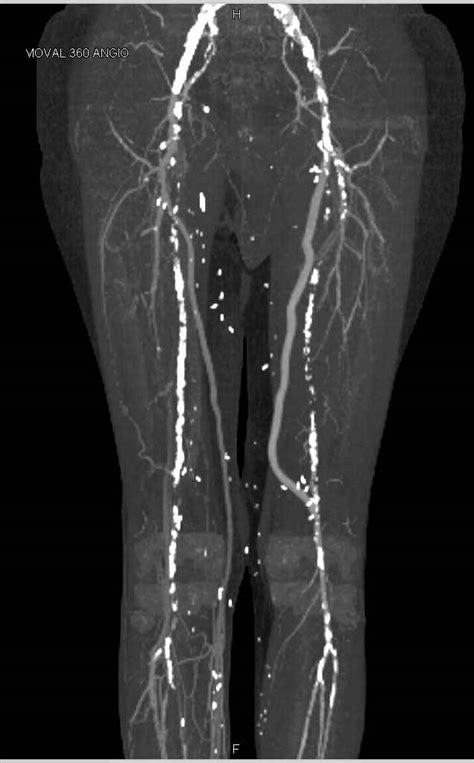 CTA Runoff with Peripheral Vascular Disease and Bypass Grafts - Vascular Case Studies - CTisus ...