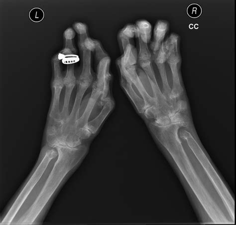 Diagnosis and early management of inflammatory arthritis | The BMJ