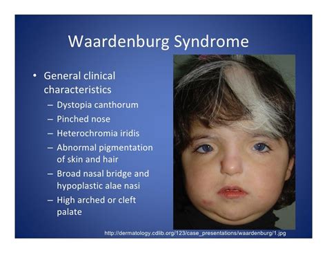 waardenburg syndrome : SNHL white forelock Waardenburg, Clefts, Hearing Loss, Med School, Roman ...