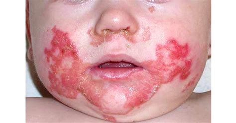 Acrodermatitis enteropathica - www.medicoapps.org