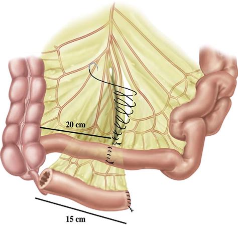 Figure 3 from Ileal Conduit as the Standard for Urinary Diversion After ...