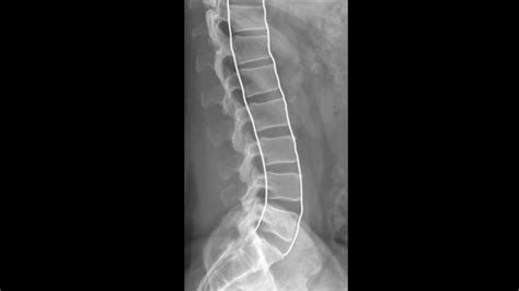 Lumbar X-ray Interpretation - OSCE Guide | Radiology | Geeky Medics