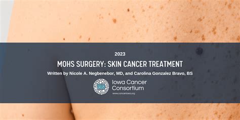 Mohs Surgery: Skin Cancer Treatment - Iowa Cancer Consortium