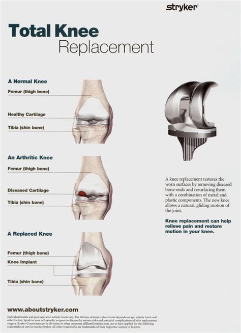 Total Knee Replacement with Stryker Navigation or OMNI Robotic-Assisted ...