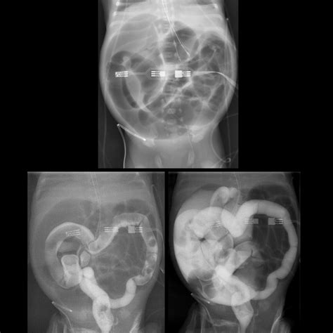 Meconium Obstruction of Prematurity | Pediatric Radiology Reference ...