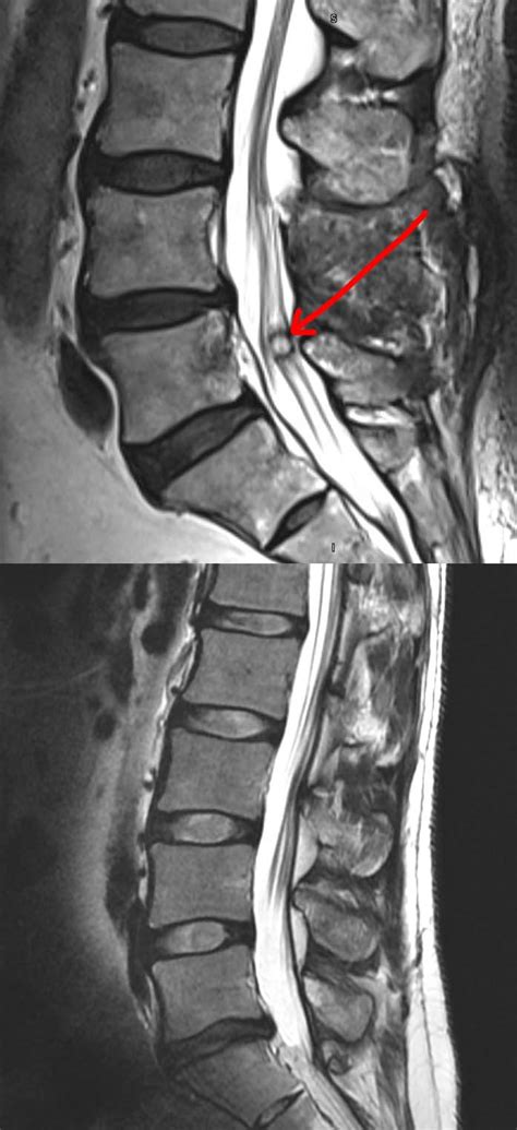 Synovial Cyst of the Spine