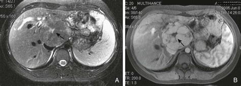 Benign Tumors of the Liver | Radiology Key