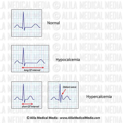 Alila Medical Media | ECG de hipercalcemia e hipocalcemia | Ilustración médica