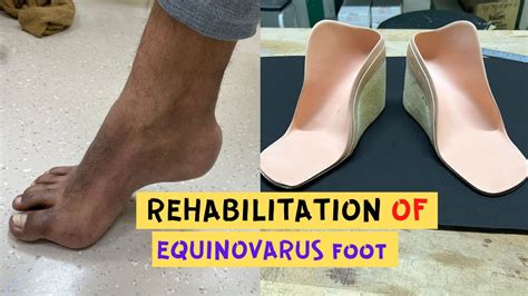 Success Story on Rehabilitation of Equinovarus Foot Deformity. - YouTube