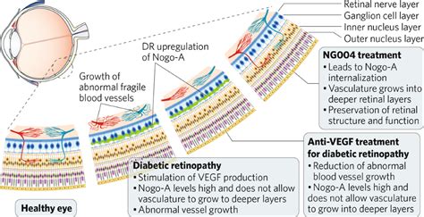 A new treatment for diabetic retinopathy