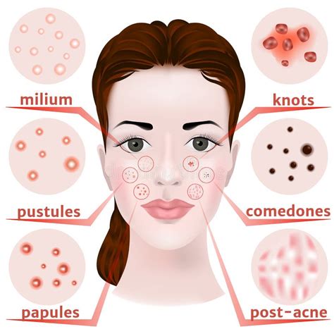 Acne on the Face. Types of Skin Diseases. Black Dots Stock Vector - Illustration of beauty ...