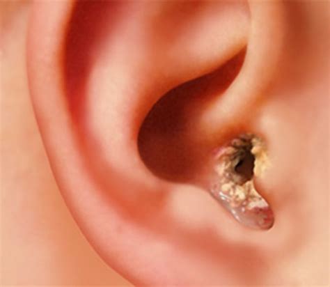 Dry Skin in Ears, Causes, Flaky, Earlobe, Crusty, No Wax, Scaly, Patch, Get Rid - (With images ...
