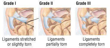 Wrist Sprain