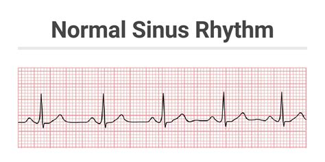 Normal Sinus Rhythm SVG