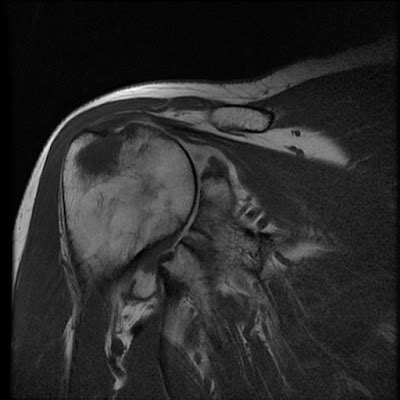 Radiology Cases: Rheumatoid Arthritis
