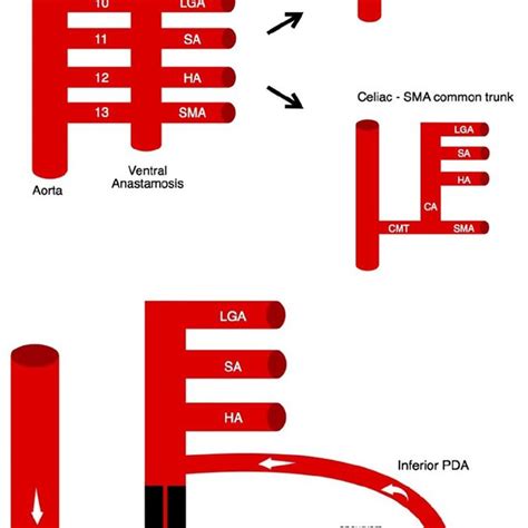 (a) Upper figure: Embryology of normal vascular anatomy and variant... | Download Scientific Diagram