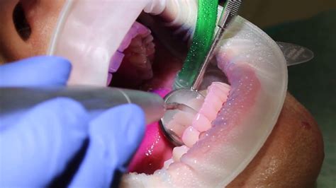 Scaling & polishing procedure in Poldent Dental Care (Cut) - YouTube