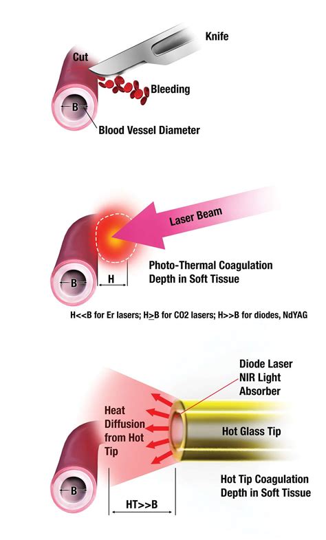 Hemostasis / Coagulation with Soft-Tissue Dental Lasers - Article Review