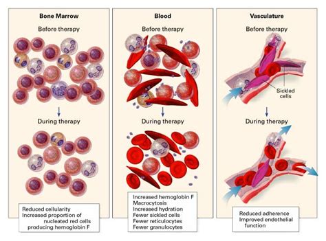 Management of Sickle Cell Disease | NEJM