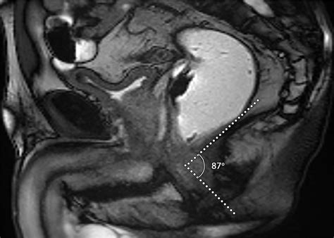 MRI of the Male Pelvic Floor | RadioGraphics