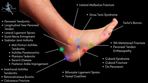 Foot Pain Diagnosis Chart Gallery Of Chart | SexiezPicz Web Porn