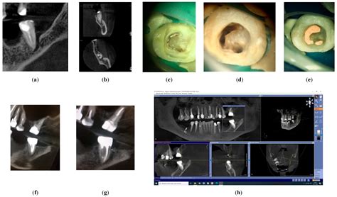 Endodontic Management of Endo-Perio Lesions