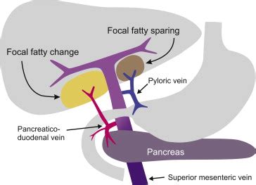 Hyperinsulinemia causes steatosis as demonstrated by these experiments... | Download Scientific ...