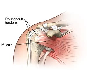 Rotator Cuff Injury | Cedars-Sinai