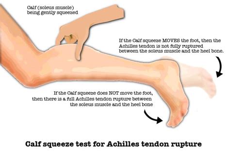 Pin on Achilles Tendonitis Exercises