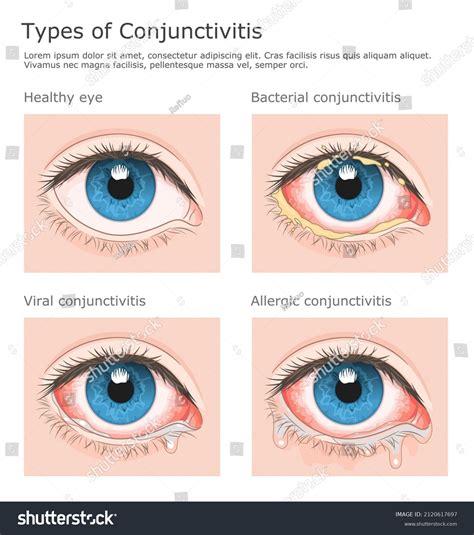 Three Types Conjunctivitis Healthy Eye Medical Stock Vector (Royalty ...