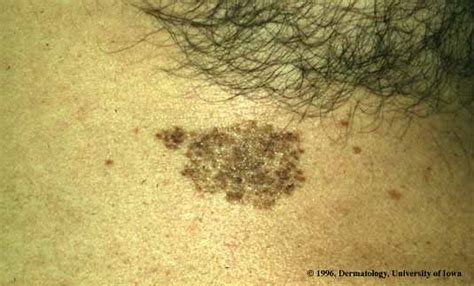 Nevus Spilus | Department of Dermatology