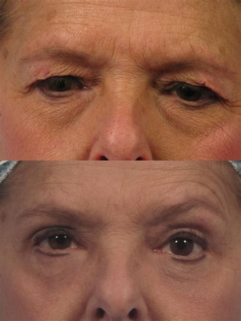 Are You Ready for an Upper Eyelid Lift? | Dr. Brett Kotlus, Cosmetic Oculoplastic Surgeon, NYC