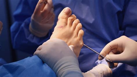 Tailor's bunion surgery with screws: A Powerful Solution