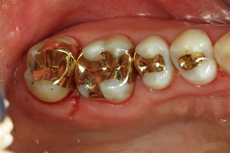 Updates in Dental Excellence: Gold Inlay Examples on My Happy Patients