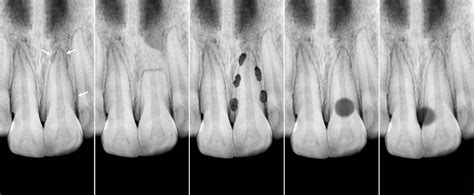 Pathological Resorption of Teeth – Dental Trauma Guide