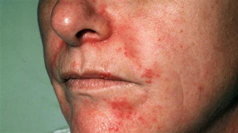 Seborrheic Dermatitis on Face Treatment, Symptoms and Pictures