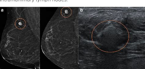 Figure 4 from Intramammary lymph nodes: Normal and abnormal multimodality imaging features ...