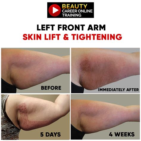 How to Instantly Tighten Loose Arm Skin | Beauty Career Online