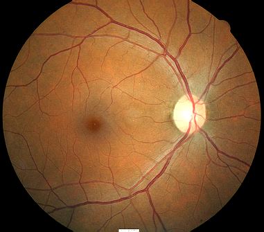 H46.11-13 Retrobulbar Neuritis (Acute) - Decision-Maker PLUS