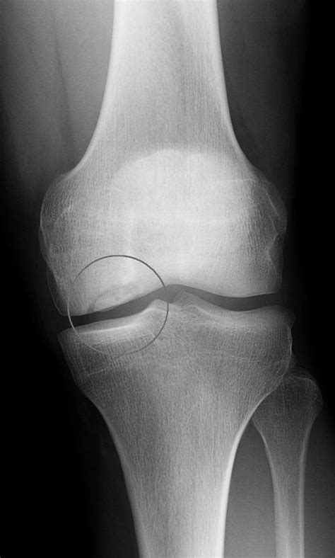 Chondral Defect Medial Femoral Condyle