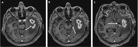 Mastoiditis and Tegmen Tympani Defect Leading to Intracranial Abscess with Actinomyces ...