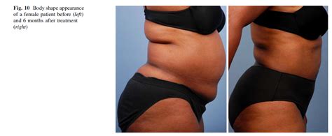 A New Approach for Adipose Tissue Treatment and Body Contouring Using – InMode Australia