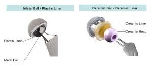 What are the types of artificial hip joints? | Dr. Shekhar Agarwal