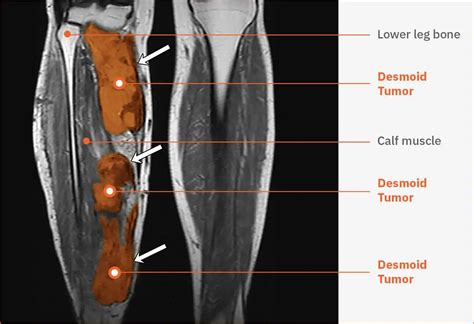 What is a desmoid tumor? - Springworks