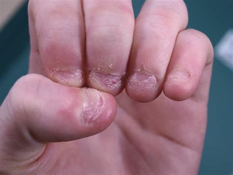 After Reading The Hazards And Adverse Effects Of Nail Biting You Will Never Bite Your Nails Again