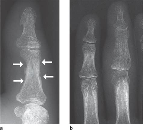 41 Osteomyelitis | Radiology Key