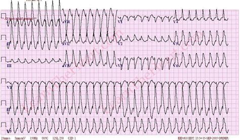 Monomorphic Ventricular Tachycardia ECG