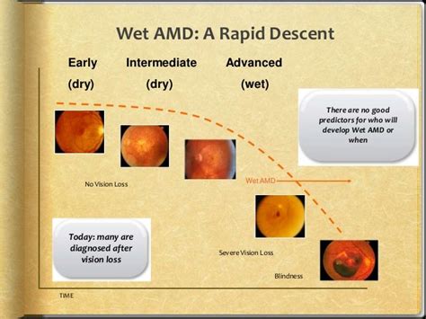 Age Related Macular Degeneration